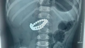 Bola 31 ta magnit yutdi: Shoshilinch operatsiya qilindi