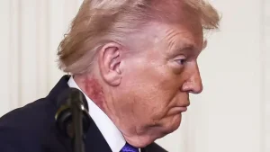 Strange marks on Trump's body discussed in the press